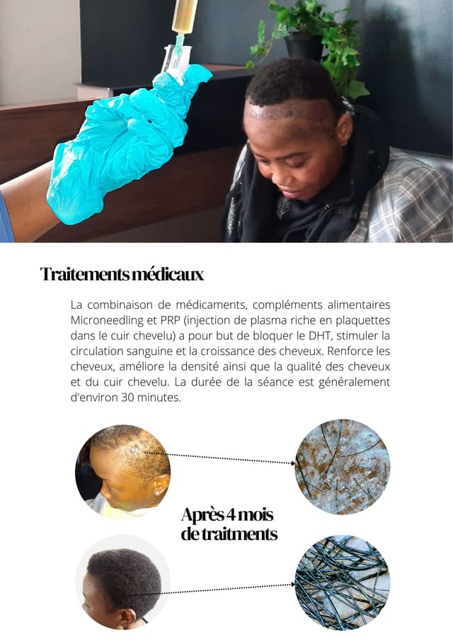 Greffe de cheveux au Cameroun